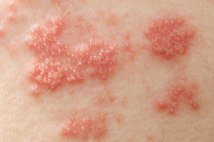 close up of shingles blisters herpes zoster virus