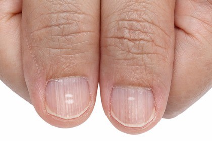 white-spots-and-vertical-ridges-on-the-fingernails
