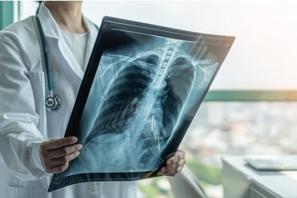 doctor-holding-lung-xray