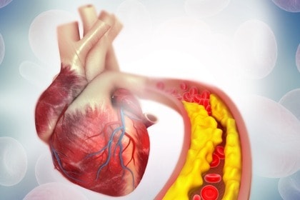 human-heart-plaque-buildup-in-arteries-atherosclerosis