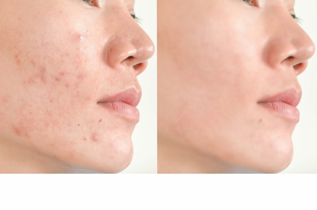 Shows the results of using vitamin c serum on acne scars.
