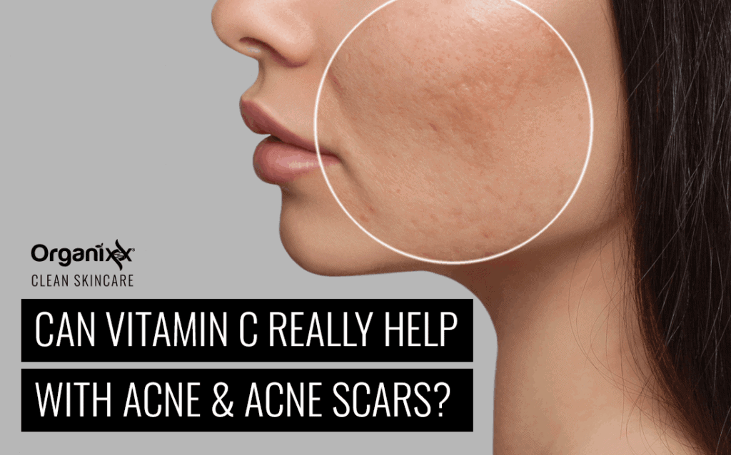 Can Vitamin C Really Help with Acne and Acne Scars?