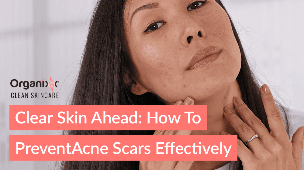 Clear Skin Ahead: How to Prevent Acne Scars Effectively