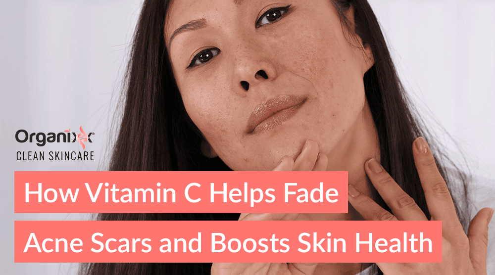 How Vitamin C Helps Fade Acne Scars and Boosts Skin Health
