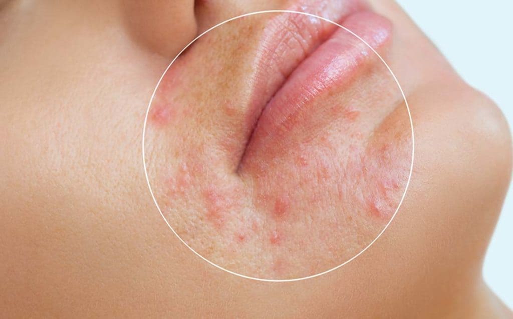 Close up showing acne on the skin - witch hazel helps control acne