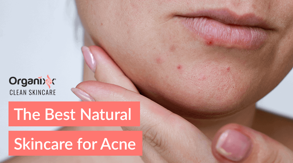 The Best Natural Skincare for Acne