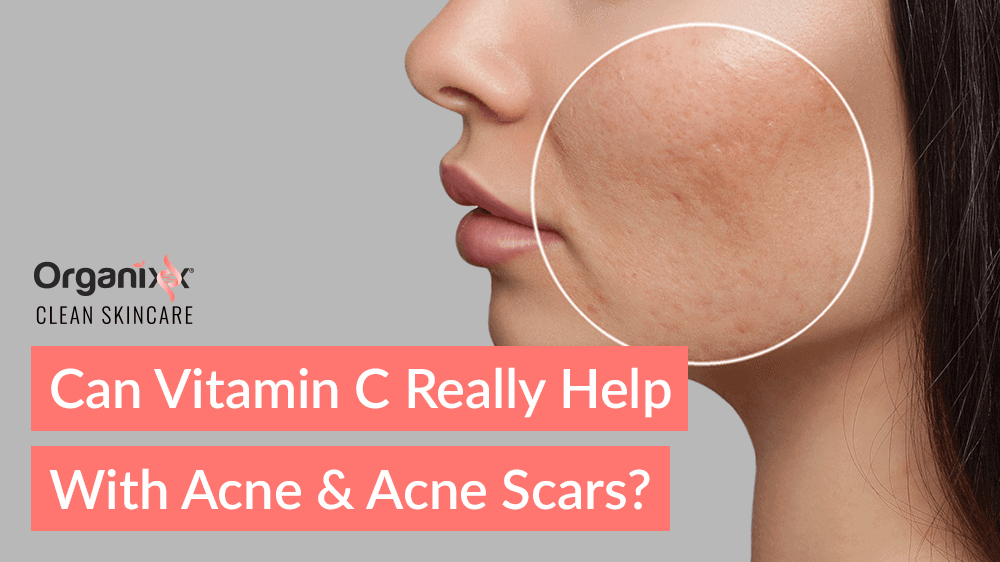 Can Vitamin C Really Help with Acne and Acne Scars?
