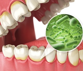 Microorganisms in the mouth that can lead to gum disease